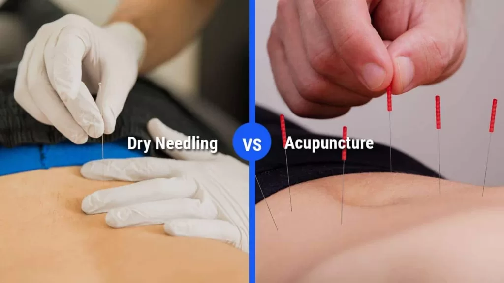 What is dry needling? And how it's different from Traditional